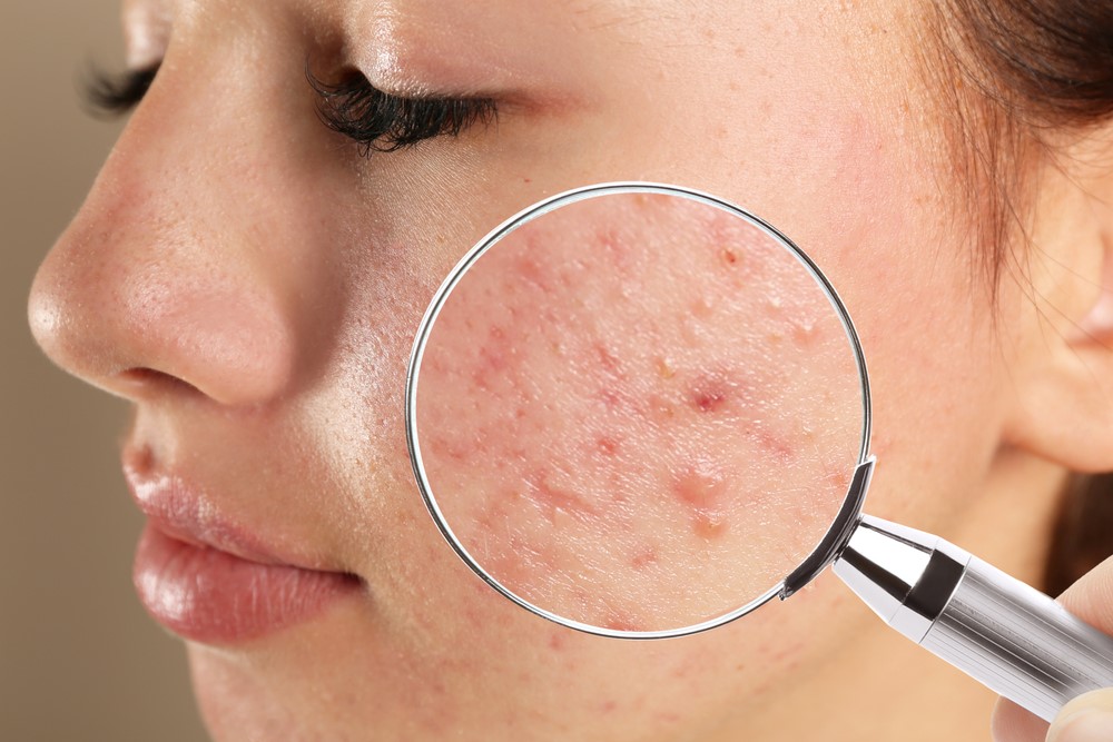 điều trị mụn nội tiết điều trị mụn nội tiết